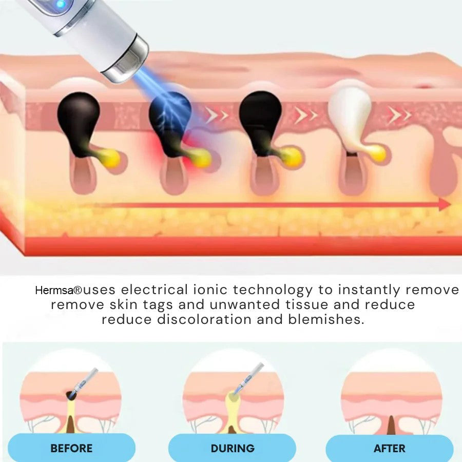 Hermsa® Removal Laser Pen