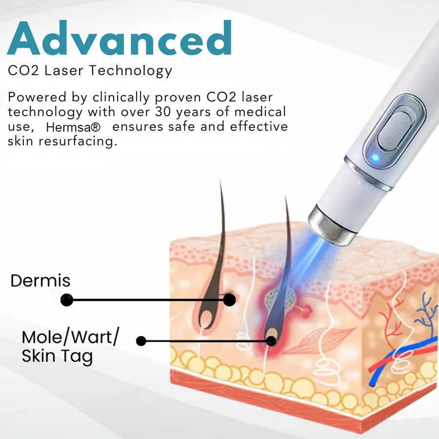 Hermsa® Removal Laser Pen