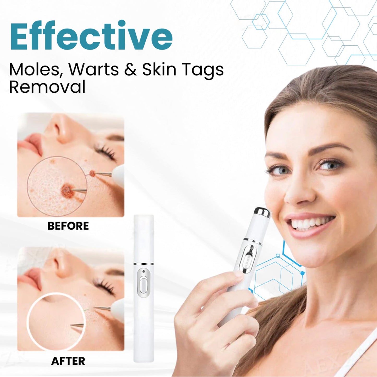 Hermsa® Removal Laser Pen